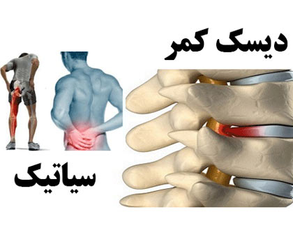 تفاوت دیسک کمر با دردهای سیاتیک
